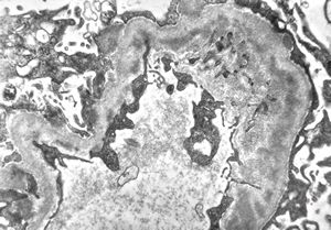 M,53y. | type III membranoproliferative glomerulonephritis